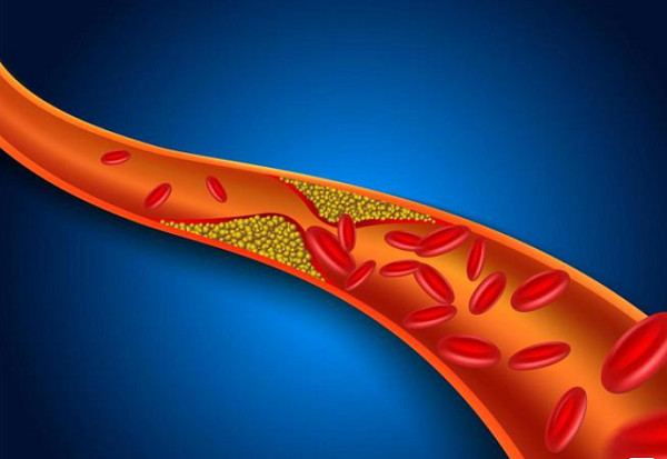 00 Acum 7.02 Colesterol mărit