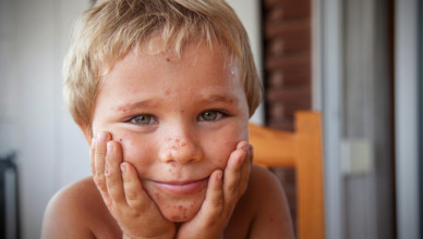 A,Little,Boy,With,A,Skin,Disease.,Skin,Diseases.,Burns