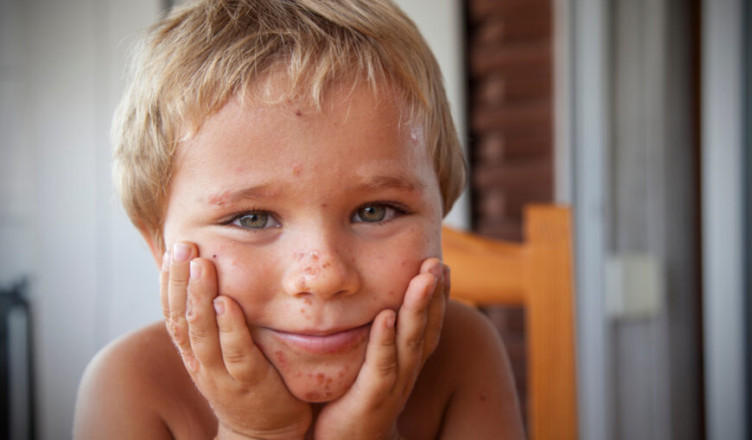 A,Little,Boy,With,A,Skin,Disease.,Skin,Diseases.,Burns